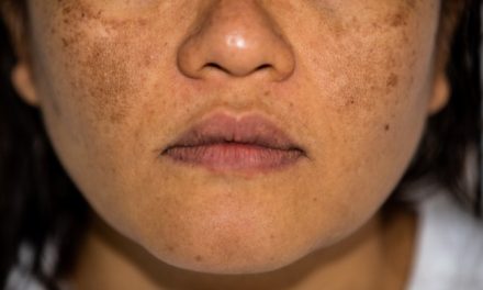 Melasma Tidak Hanya Di Alami oleh Orang di Atas 40 Tahun