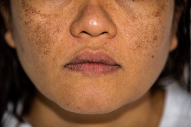 Melasma Tidak Hanya Di Alami oleh Orang di Atas 40 Tahun